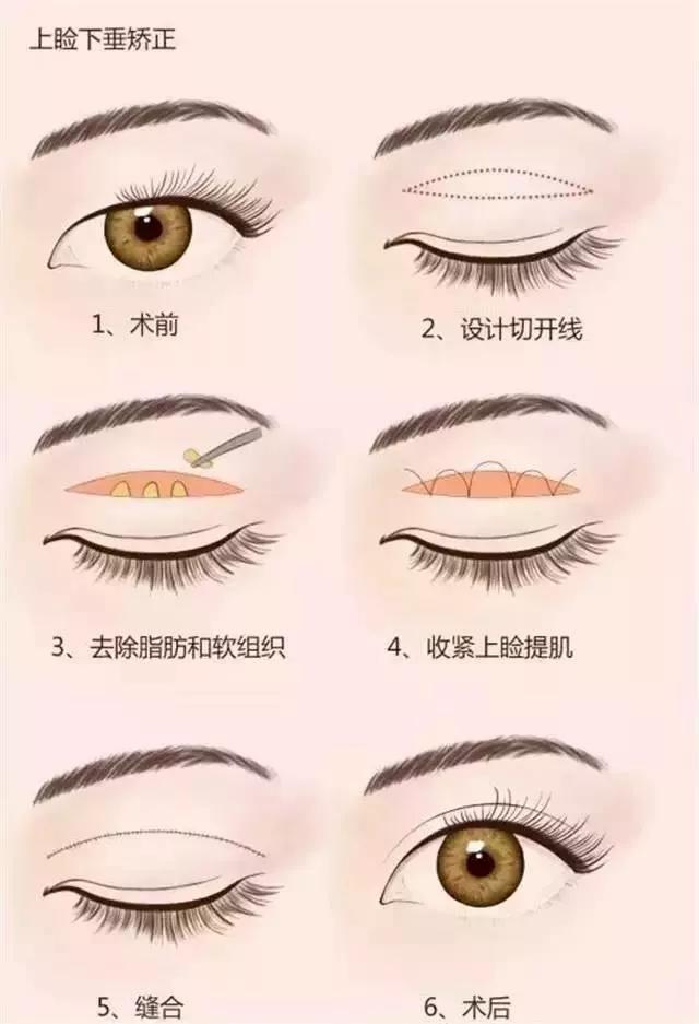 上眼睑皮肤缺损最佳的手术方法是,眼睑全层撕裂的修补术