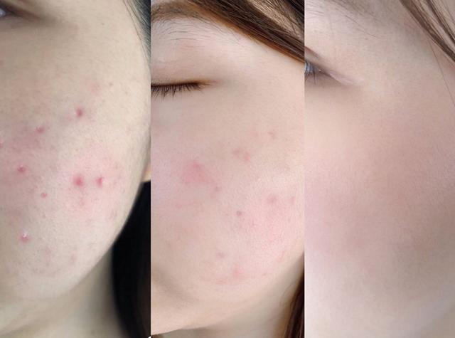 闭口反反复复长到底怎样才能根治,闭口反反复复长怎么办