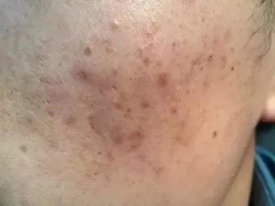 最好的解决痘痘的方法,找到问题的根源去解决痘痘