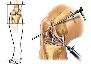 膝关节积液是脓液磁共振显示吗,磁共振显示膝盖大量积液