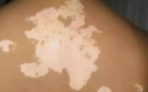 头皮白癜风症状好转图片,白癜风好转的几个迹象图片