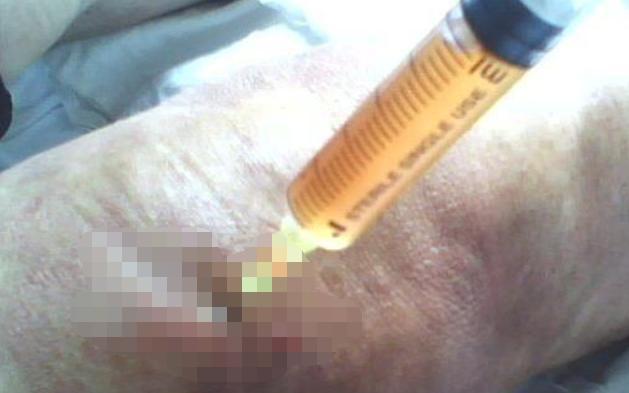 膝关节有积液怎么治疗最好,膝关节积液可以抽出来吗