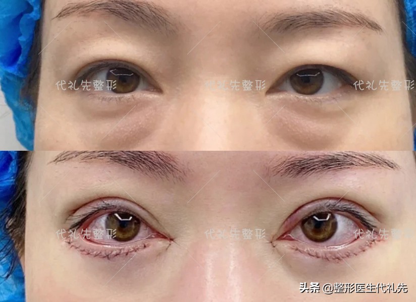 微创祛眼袋和手术开刀哪种效果好,祛眼袋手术术后眼睛青紫怎么办