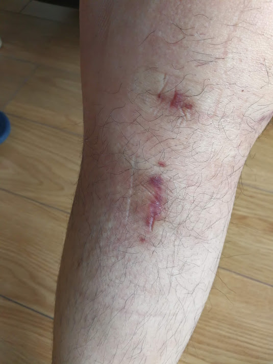 瑞典墨尼克敷料,瑞典墨尼克美皮护疤痕贴有效吗