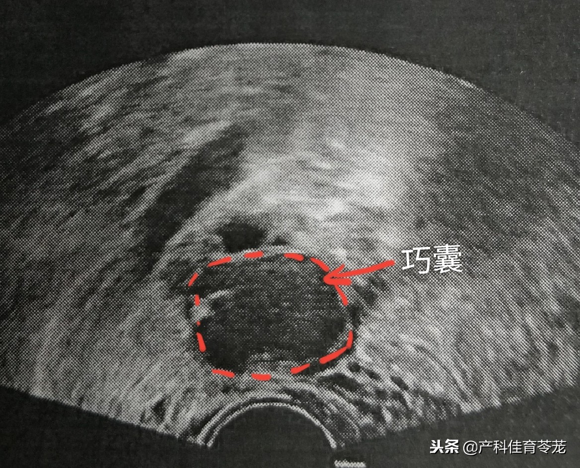卵巢囊肿术后还有囊肿,卵巢囊肿是肿瘤性囊肿怎么治疗