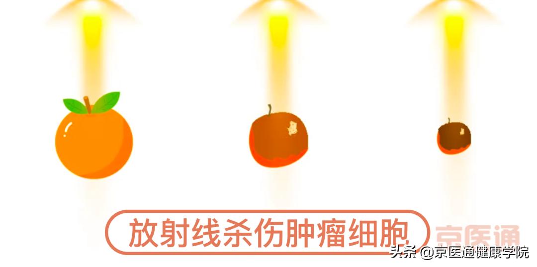 放射治疗别担心肿瘤杀手来帮您,肿瘤的放射治疗辐射