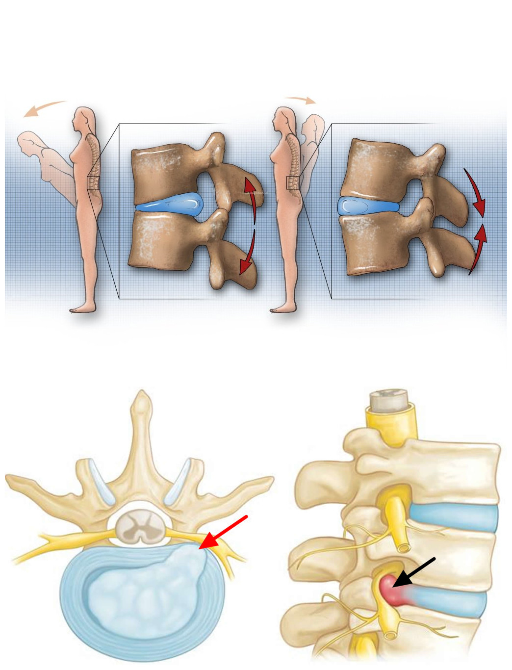 治疗腰椎间盘突出的方法与思路,腰椎间盘突出腰腿酸痛多久能好