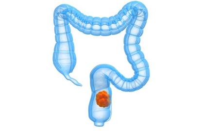 长期便秘对肠道有危害,女性长期便秘有什么危害