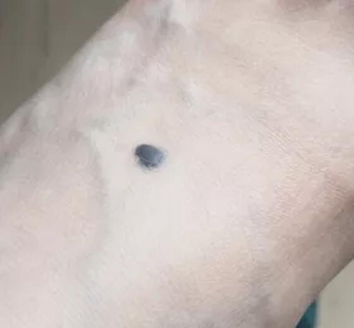 哪些部位长痣预示一生劳碌,痣的位置预示着什么