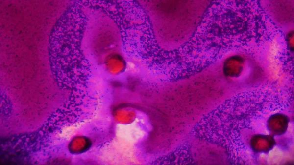 淋巴结忽大忽小是癌吗,淋巴结一年多一直那么大要紧吗