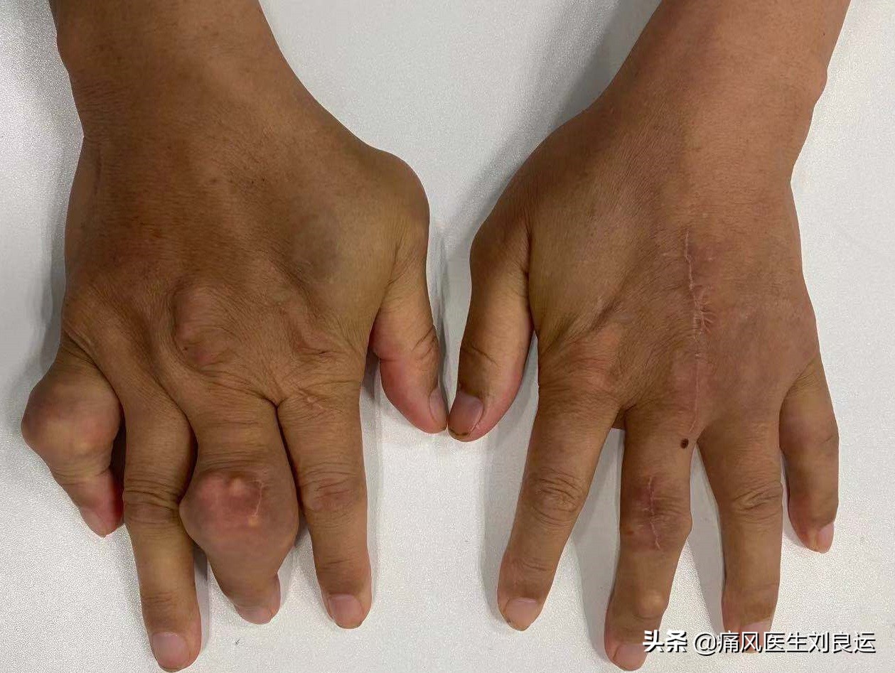 痛风会在脚趾和膝关节同时发作吗,痛风发作从脚趾头到脚踝又到膝盖