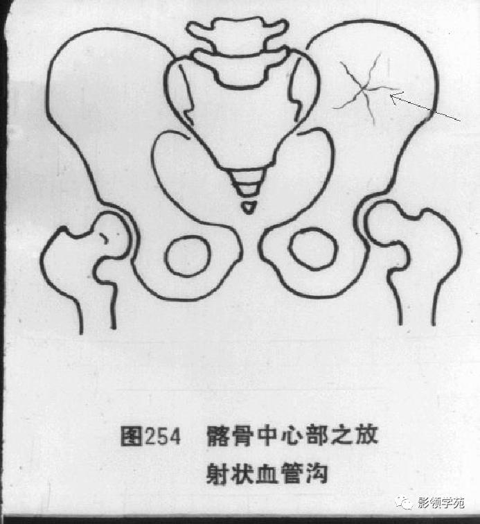 桡骨远端骨折引起尺骨变异,撕脱骨折一个月无明显骨痂形成