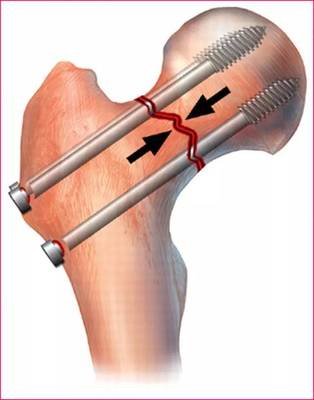 老年人骨质疏松严重造成腰骨折,髋部骨折包括哪些骨折