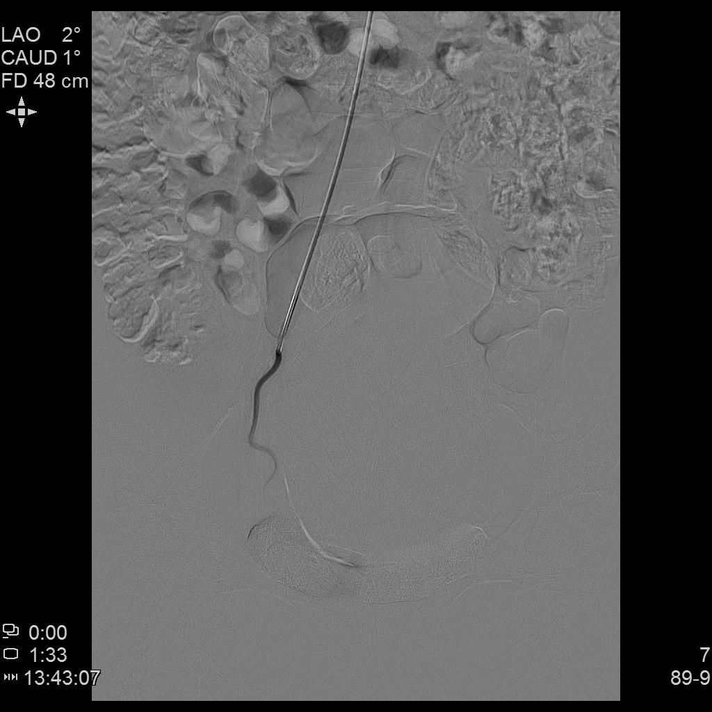 子宫腺肌症介入栓塞全国哪里好,子宫腺肌症介入栓塞治疗报销吗