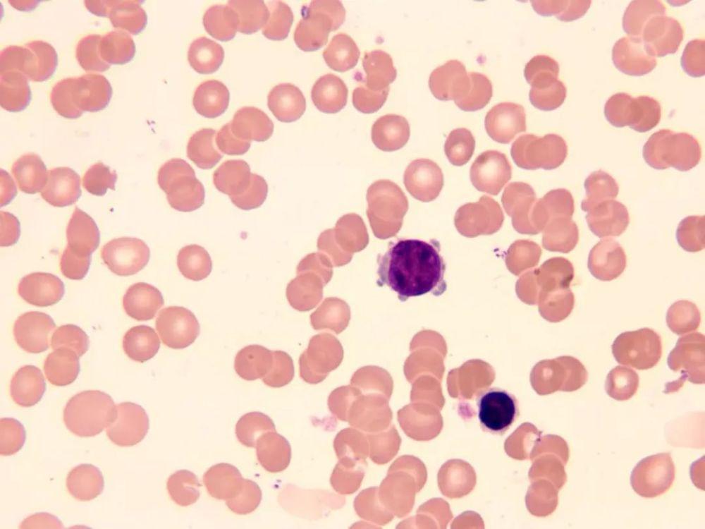 传染性急性单核细胞增多症,传染性单核细胞增多症有哪些