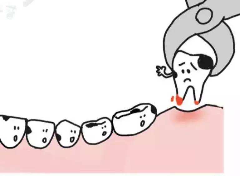 有牙洞用含氟牙膏,牙齿涂氟小知识