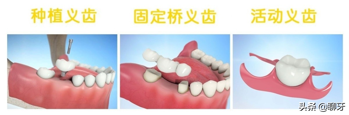种植牙是什么种植技术,种植牙一般要怎么种植的