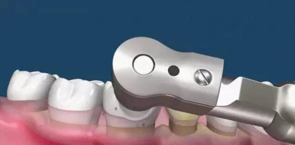 洗牙到底怎么洗好,洗牙洗的不干净