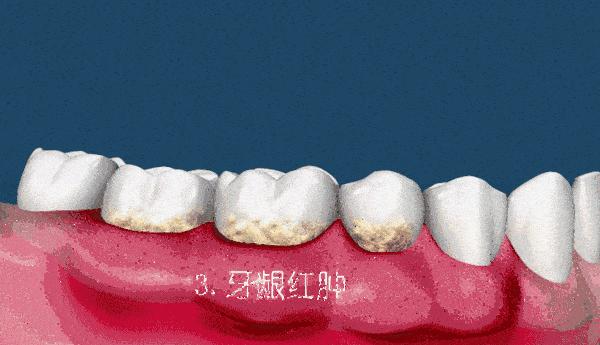 牙龈出血牙齿松动怎么解决,牙龈松动出血是什么原因引起的