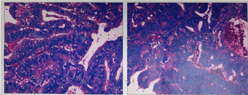 子宫内膜癌绝经后出血,绝经后的子宫内膜癌初期出血量