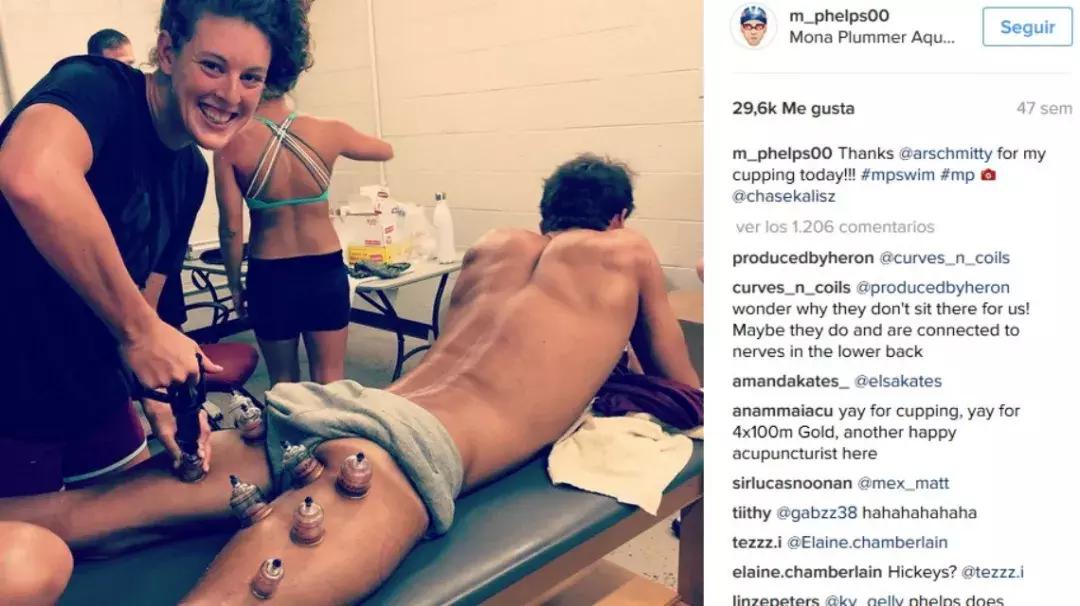 老外有多迷恋拔火罐,外国人吐槽中国拔罐