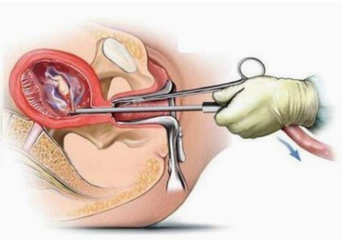 如何防止流产的风险,如何预防人工流产的并发症