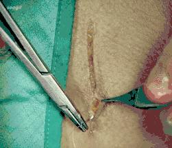 十种外科基本缝合方式详解,手术切口缝合有哪几种