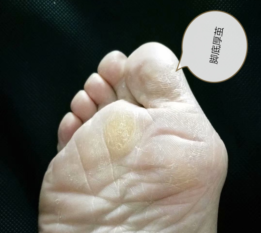 大脚趾外翻怎么锻炼恢复正常,大脚趾外翻矫正危害