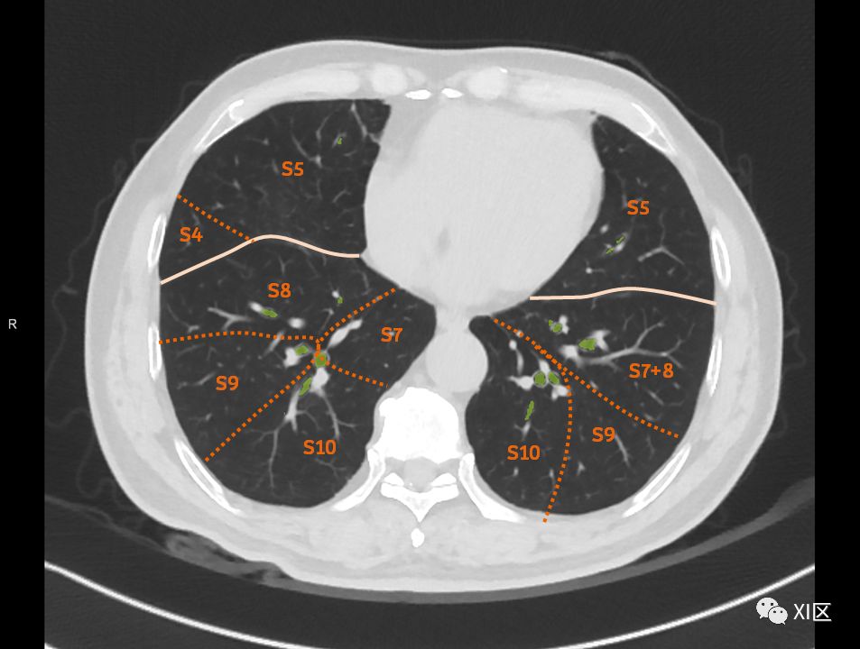 如此详细的肺部影像解剖，有点儿酷