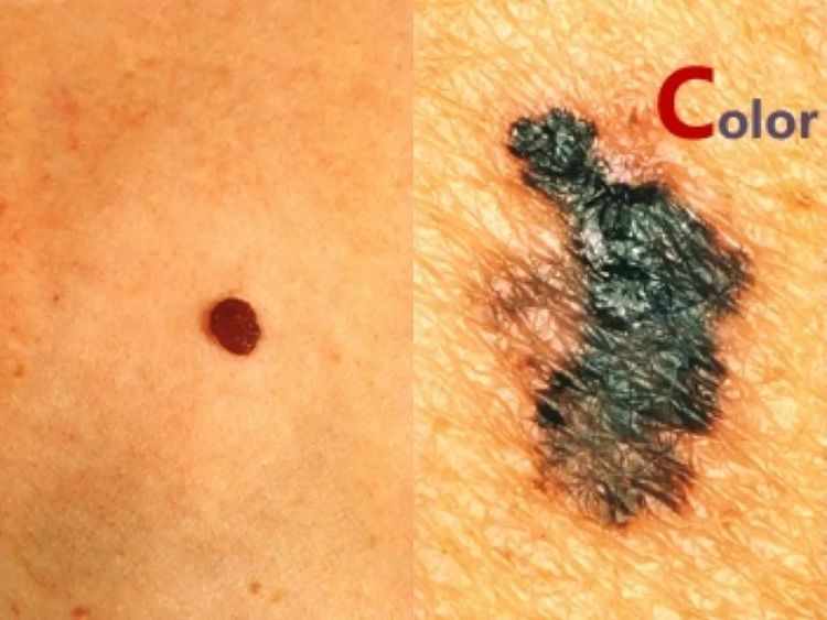 黑色素痣癌变的前兆切除能治愈吗,激光点黑色素痣能诱发恶变吗