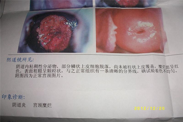 28岁女博士查出宫颈癌，平时洁身自好，医生提醒：这1件事要注意