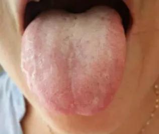 皮肤祛湿的方法,要想皮肤好排毒少不了