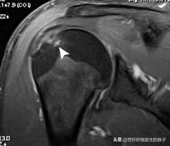 肩颈椎疼怎么办最快最有效,颈椎肩周痛有什么办法解决