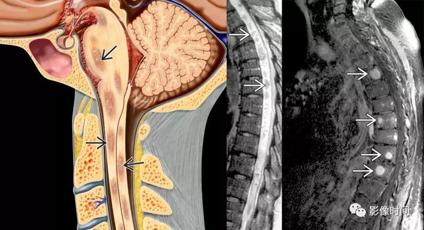 脊髓病变案例图文问诊,脊髓病变视频