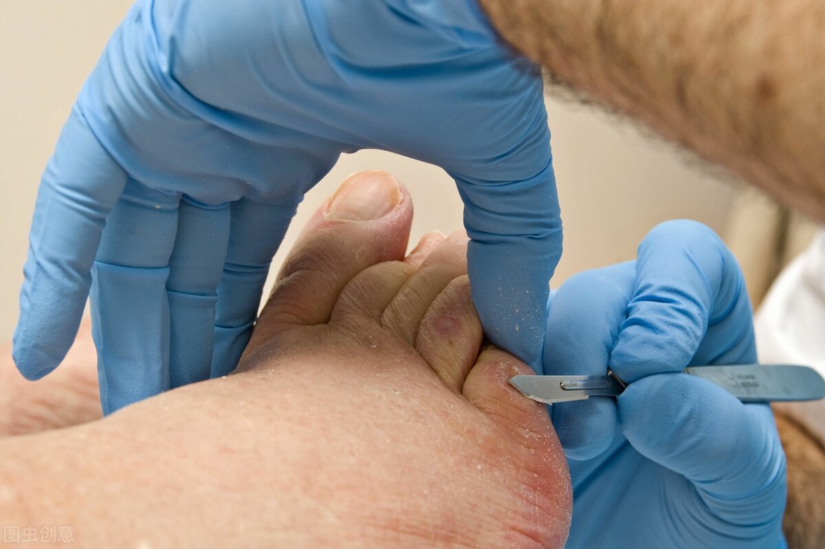 糖尿病为什么会出现糖尿病足呢,糖尿病怎么不出现糖尿病足