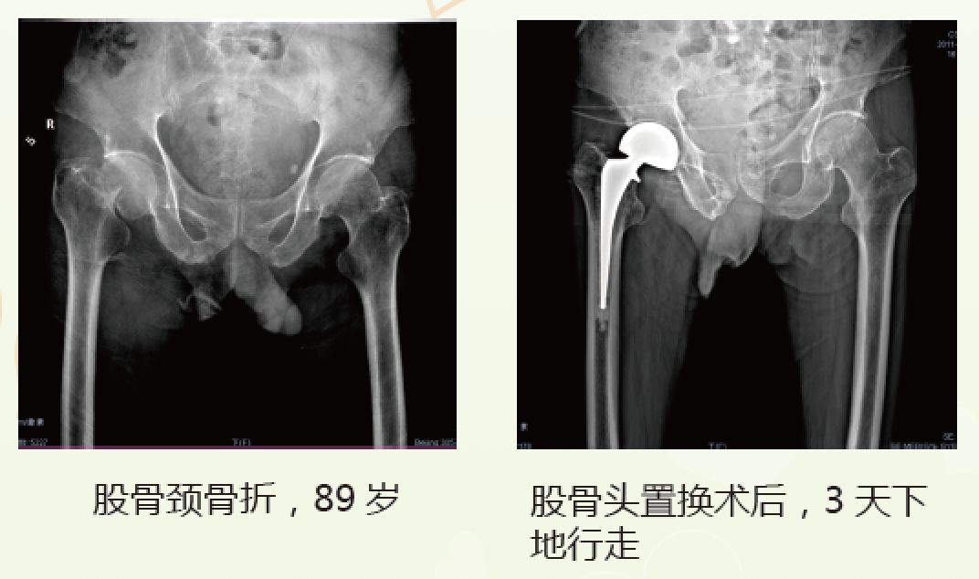 髋部骨折对老年人来说意味着什么,老人髋部骨折多长时间恢复到正常