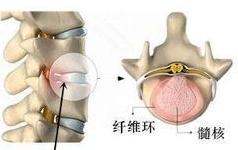 腰椎间盘膨出突出脱出有区别吗,腰椎间盘膨出和突出的中医治疗