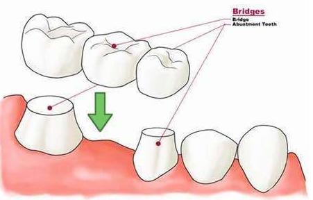 固定牙搭桥多少钱,固定桥修复牙齿价格