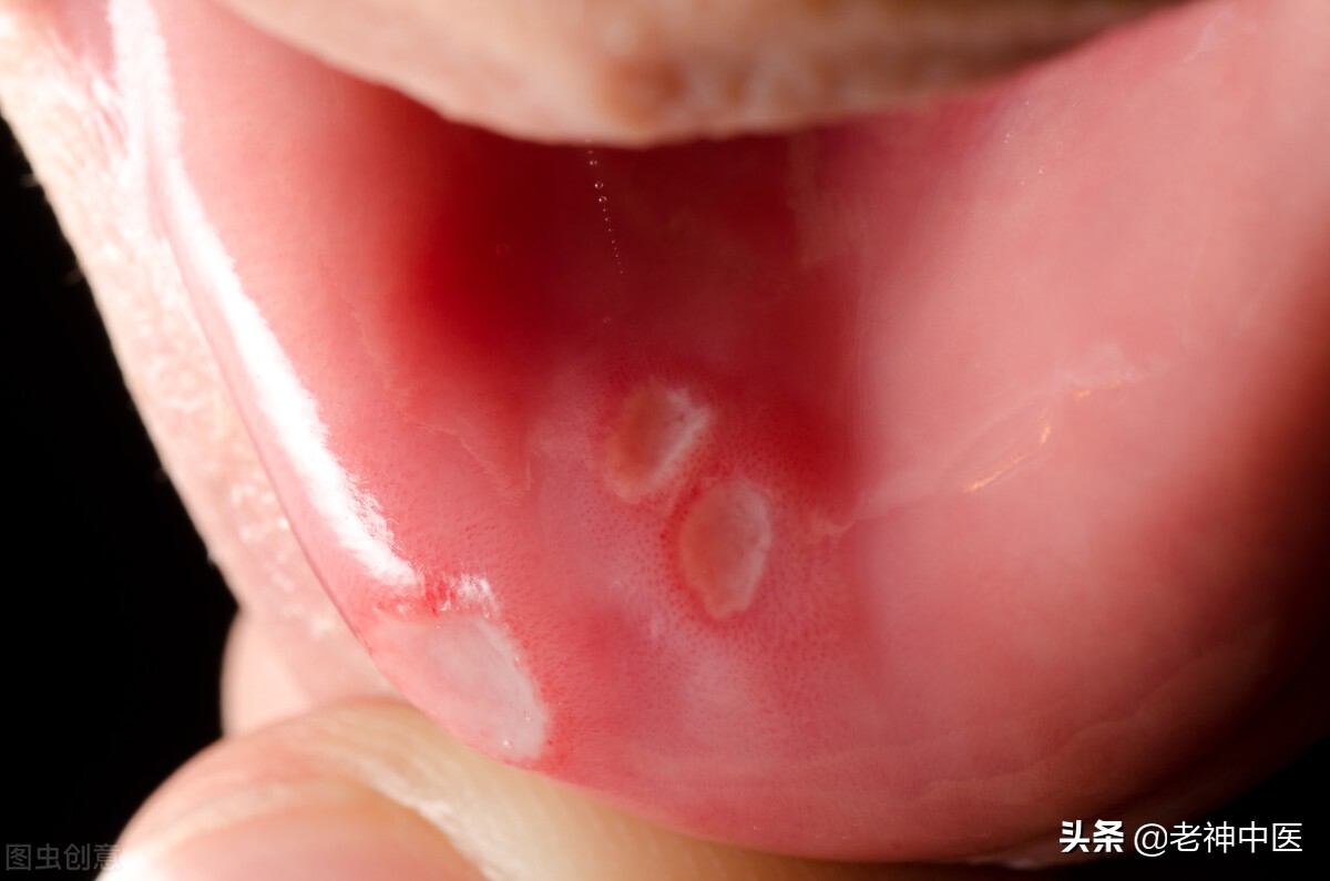 孩子口舌生疮，疼痛太难当；引热从小便解，用宋时古方