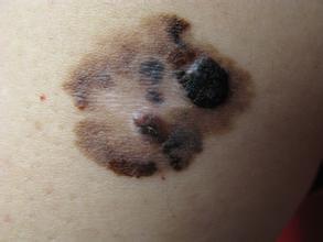 身上的红色痣怎么去掉,身上的痣能随便去掉吗