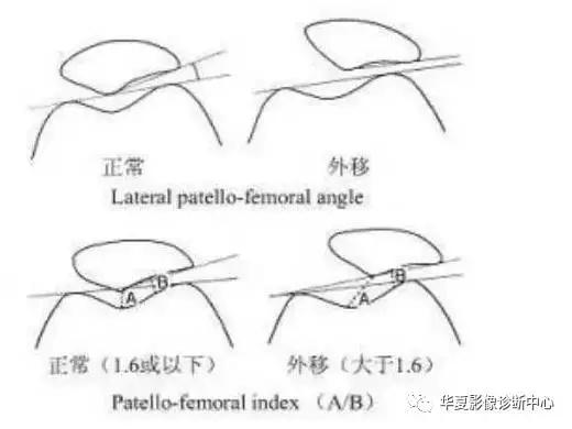 膝关节痛警惕四种病,科普膝关节疼痛影响到的22种疾病