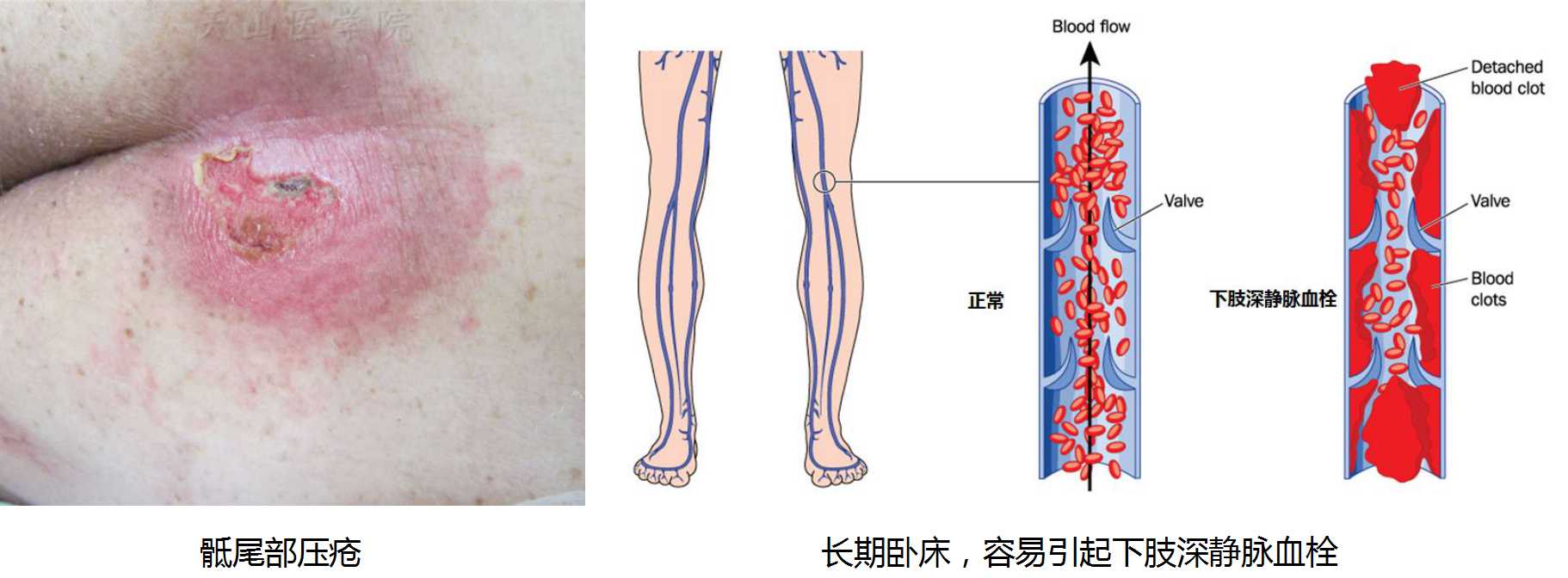 70岁老人腰骨折需要手术么,70岁老人腰椎骨折是保守还是手术