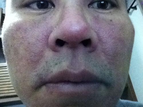 为什么鼻翼两侧发红还长痘,为什么会鼻翼两边泛红发痒