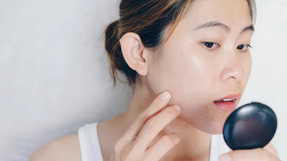 怎么祛痘印最有效的方法有哪些,怎么祛痘印最快方法