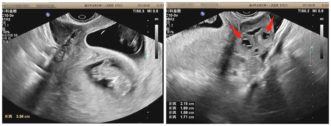 怀上四胞胎的概率是多少,宫内宫外同时怀孕是双胎吗
