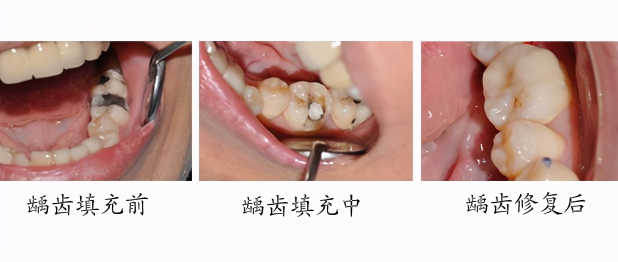 蛀牙修复之后要注意什么,蛀牙了在家里就能解决的办法