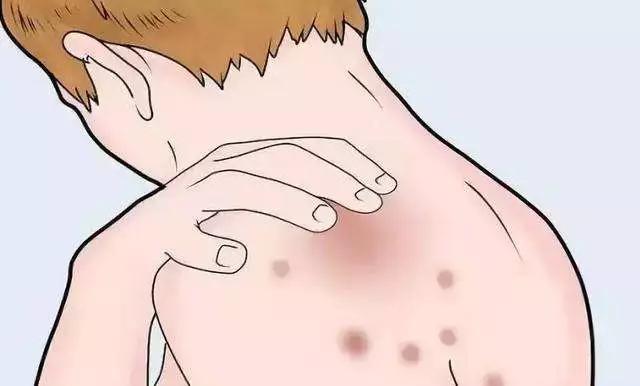 抑菌乳膏治疗皮肤痒,皮肤科常用的止痒软膏有哪些