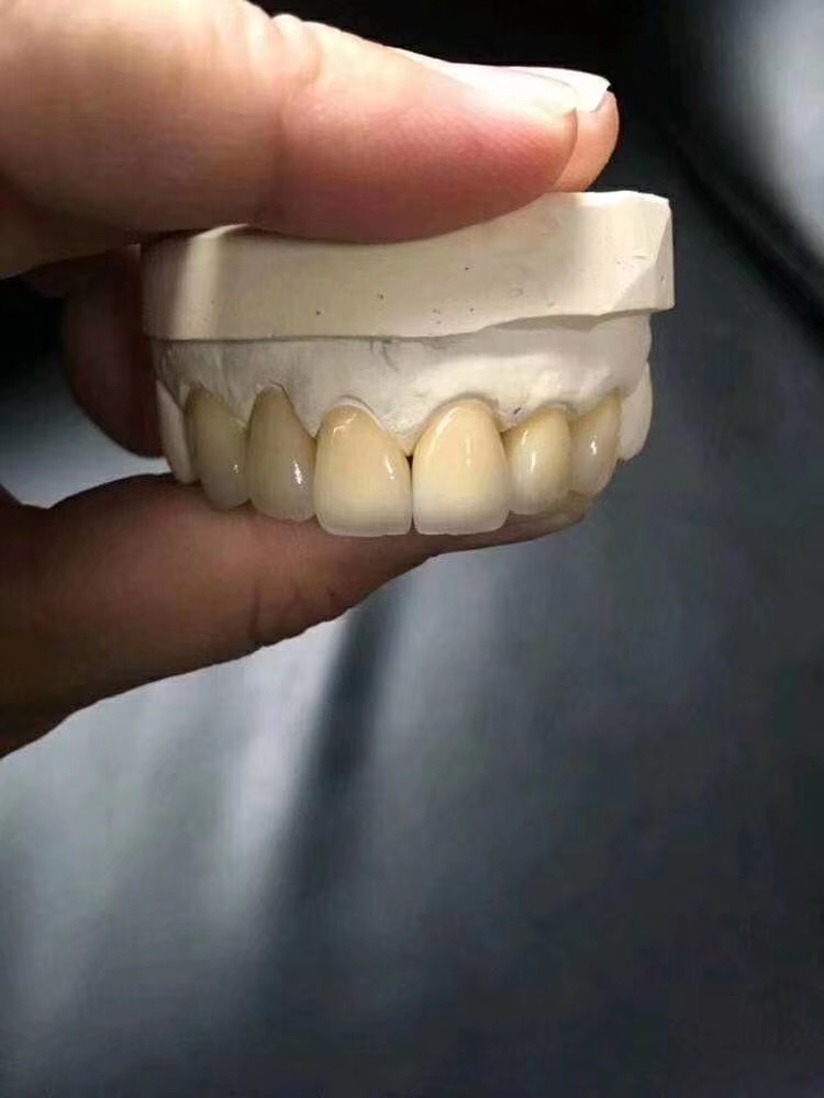 已经有牙洞了怎么根管治疗,牙髓腐烂坏死再做根管治疗会痛吗