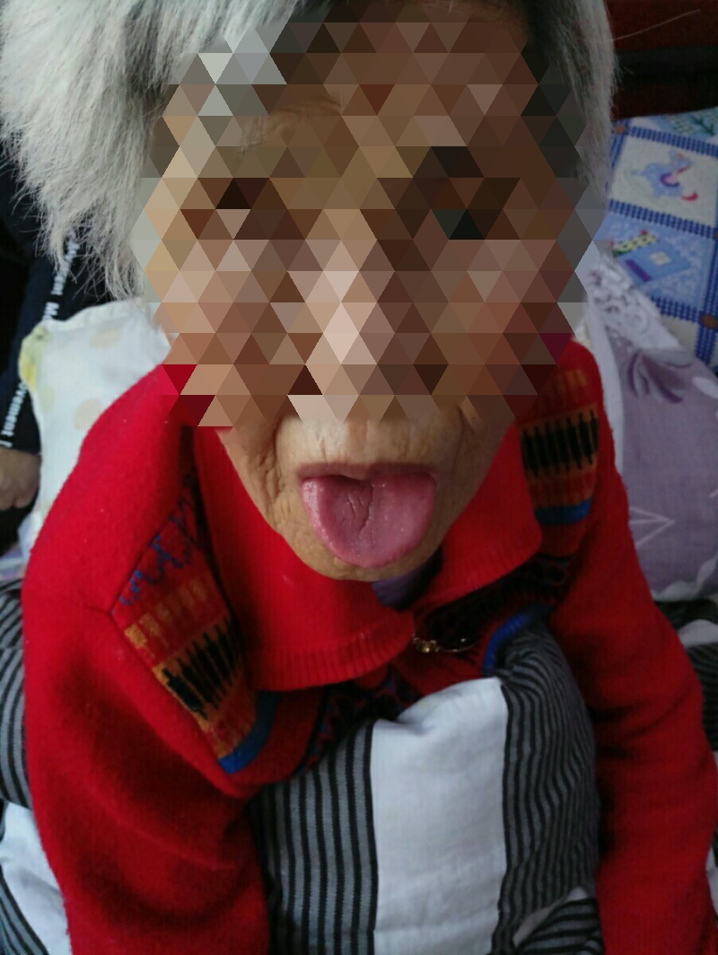 附子治疗心脏病医案,大量吃附子治心衰