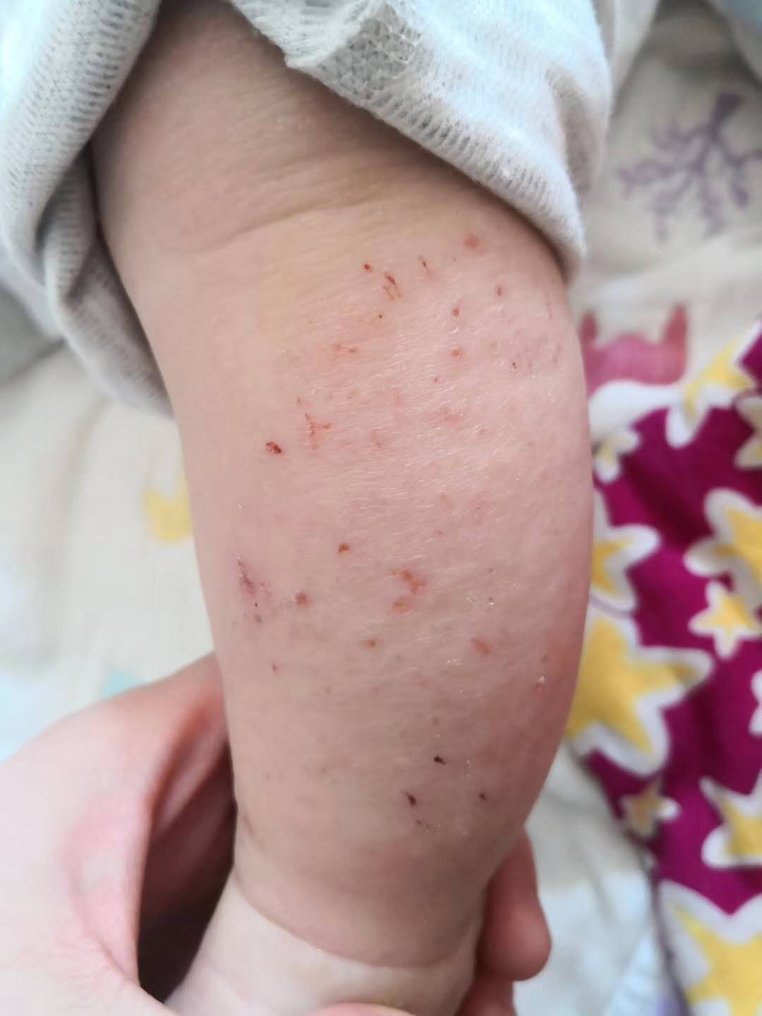 湿疹和接触性皮炎的用药,跟湿疹战斗的日子